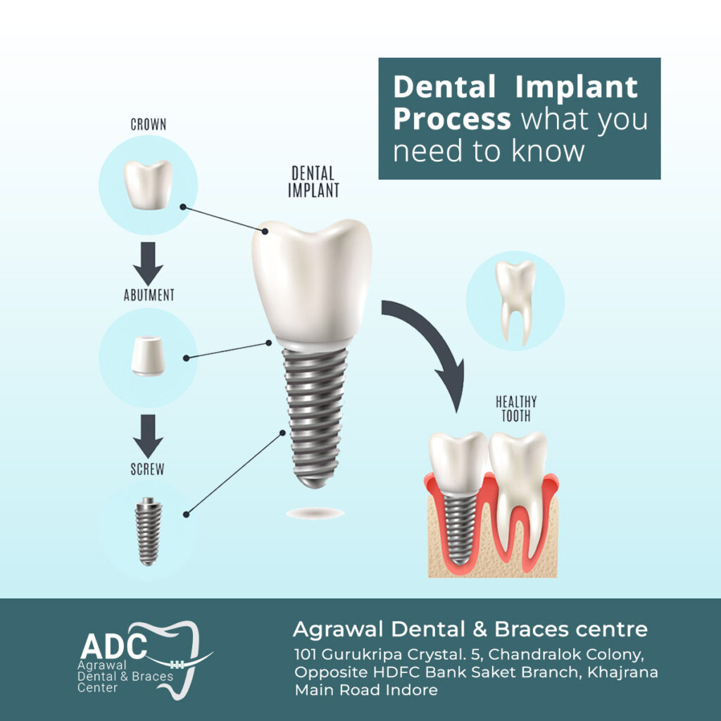 Dental Implant Process What You Need to Know - Agrawal Dentist Indore