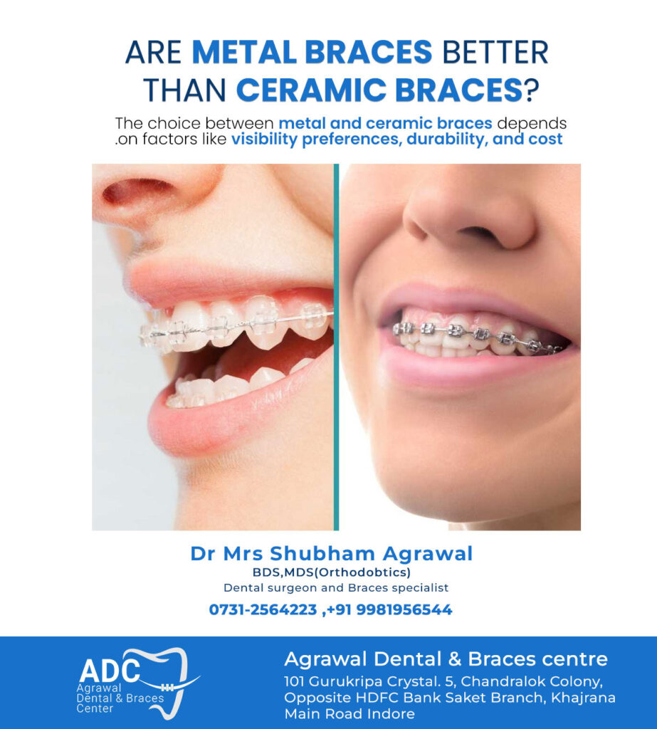 Clear vs Metal Braces: Pros & Cons, Costs & Prices